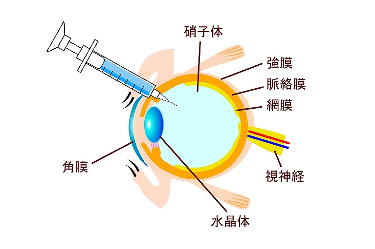 抗VEGF抗体治療（硝子体注射）