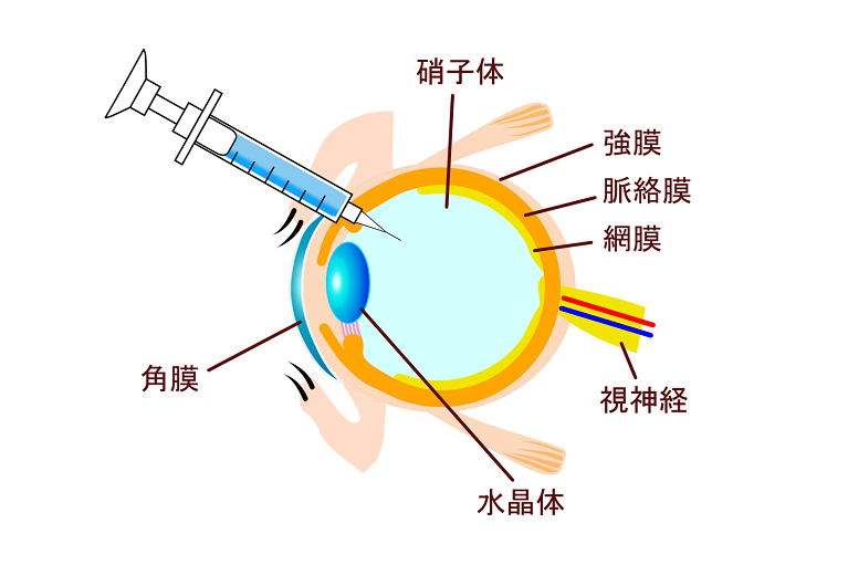 抗VEGF抗体治療(硝子体注射)とは