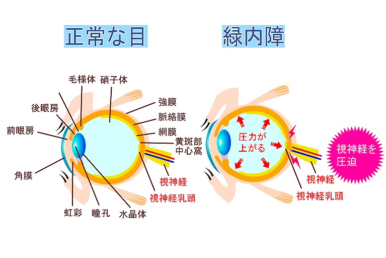 緑内障とは