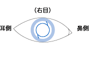 眼内レンズの挿入