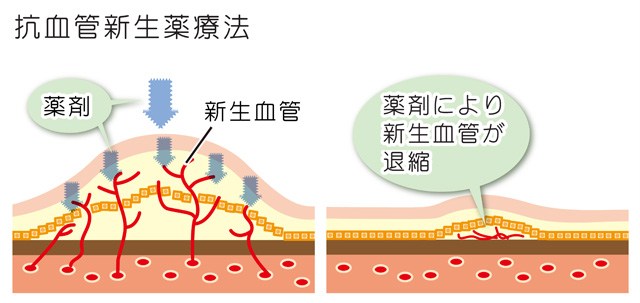 抗VEGF抗体(抗血管新生薬)について