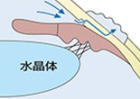 最後に強膜弁、結膜を縫合します。術後の房水の排出経路はこのようになります。