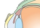 強膜弁下の輪部深層組織を切除し、周辺虹彩を切除します。
