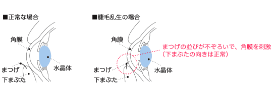 睫毛乱生