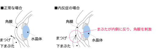 内反症